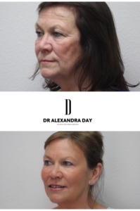 Dr-Day-Fillers